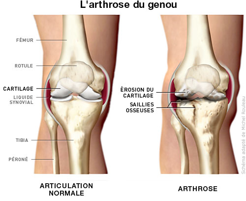 Arthrose du genou